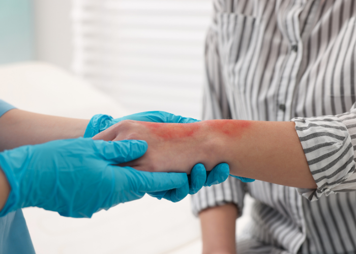 curación de heridas a domicilio